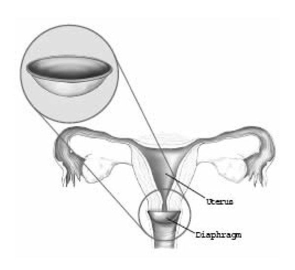 Illustration of the diaphragm method of birth control