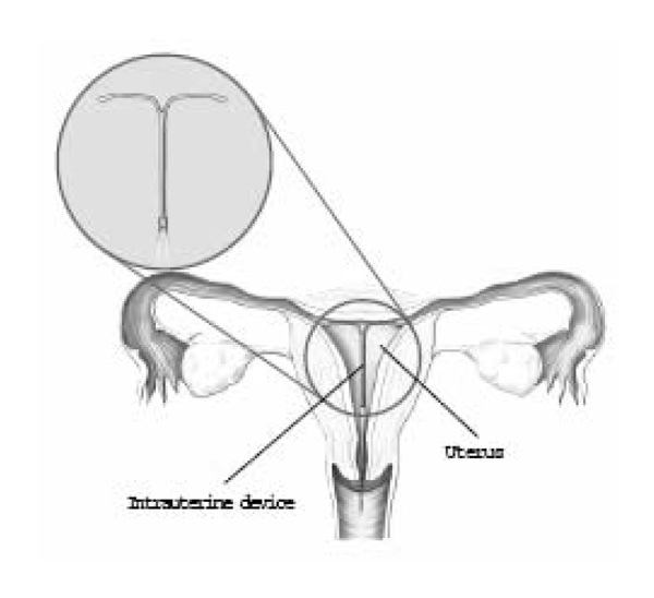 Illustration of the intrauterine device method of birth control