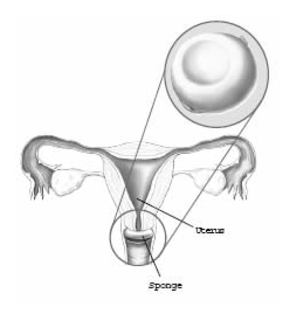 Illustration of the sponge method of birth control