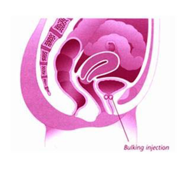 Bulking injections illustration